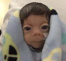 Newborn with Cornelia de Lange Syndrome in a blanket