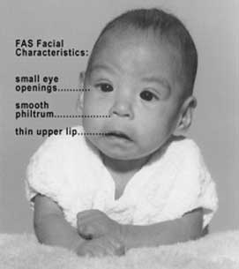 Facial Characteristics of Fetal Alcohol Syndrome with labels: Small eye openings, smooth philtrum, thin upper lip